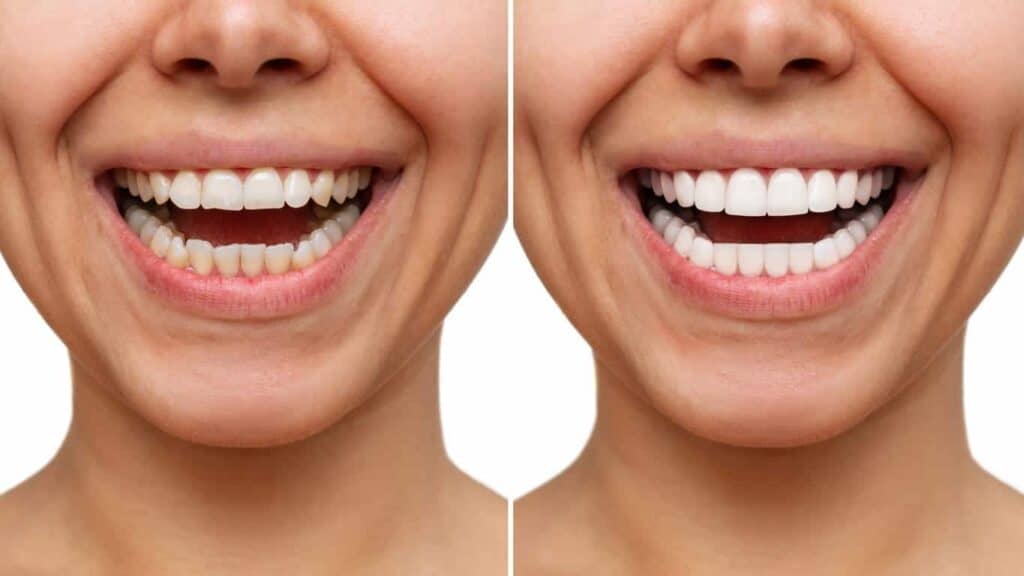 Before and after teeth whitening results. Archway