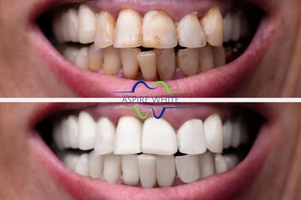 Before and after results of laser teeth whitening Archway Book in online today!